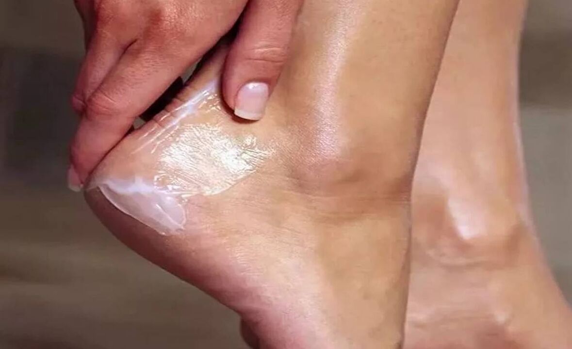 Si të trajtojmë kërpudhat e këmbëve me krem ​​fantastik