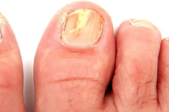 dëmtimi i pllakës së thonjve për shkak të një infeksioni mykotik