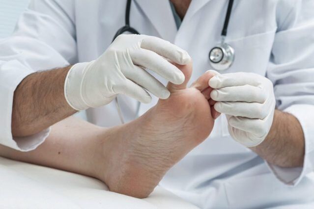 diagnoza e kërpudhave në këmbë nga një mjek